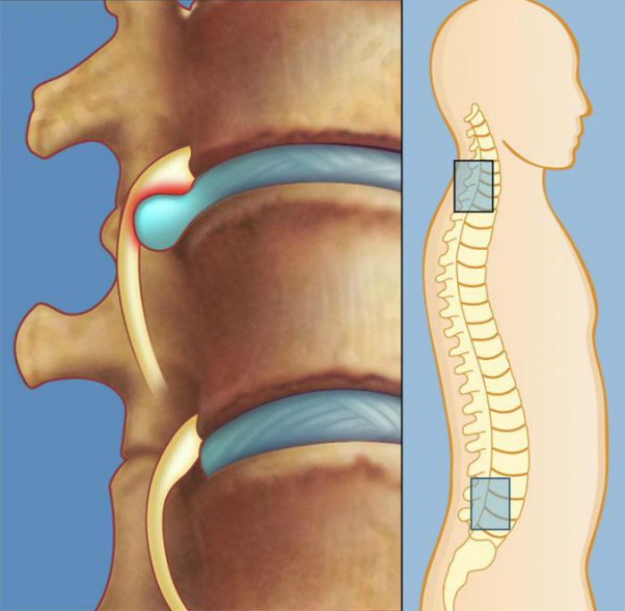 Лечение межпозвоночной грыжи без лекарств и операции: упражнения для спины от Шамиля Аляутдинова.